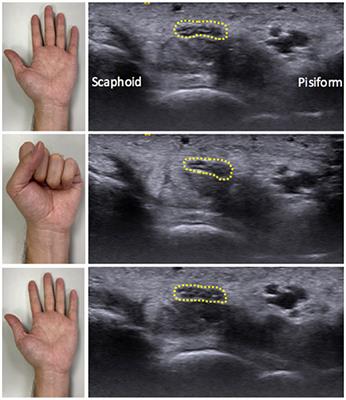 Dynamic Ultrasound Assessment of Median Nerve Mobility Changes Following Corticosteroid Injection and Carpal Tunnel Release in Patients With Carpal Tunnel Syndrome